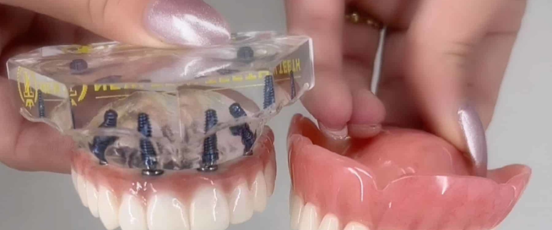 What is a better option than dentures?
