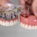What is a better option than dentures?