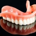 What are the four types of dentures?